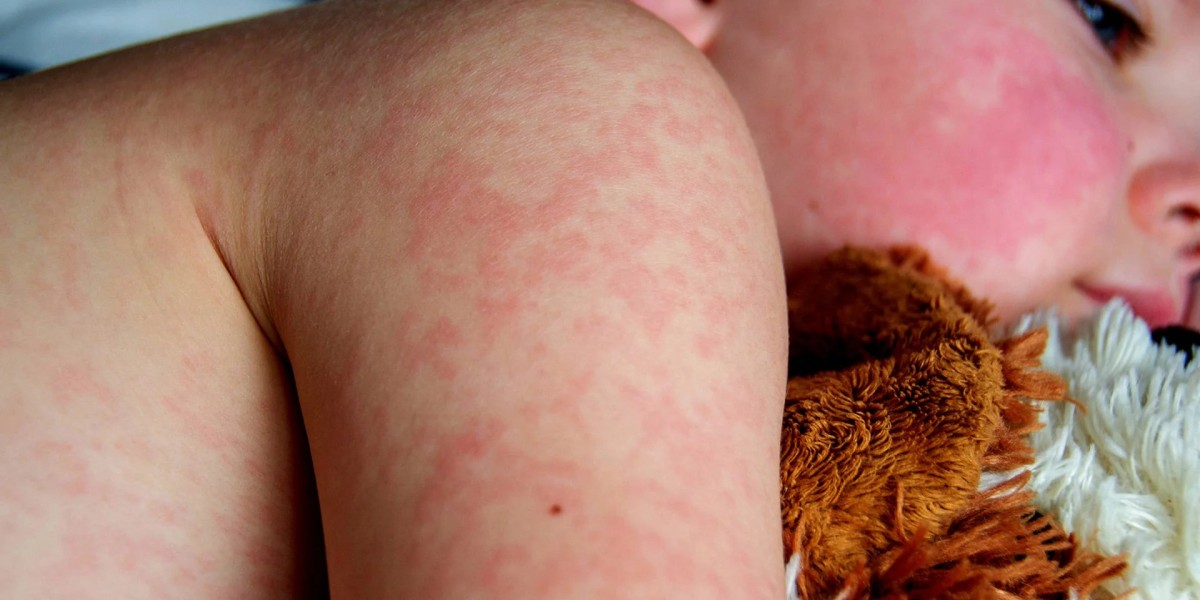 Manzanilla for Baby Skin: Safe and Effective Tips