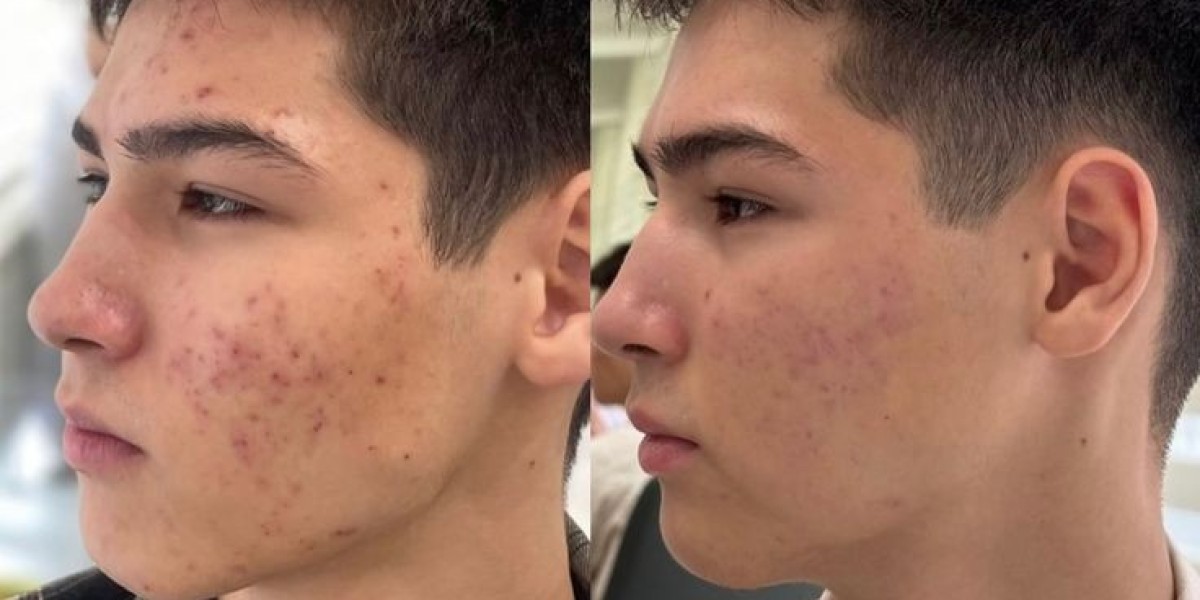 Professional Approaches That Help Improve Acne-Affected Skin